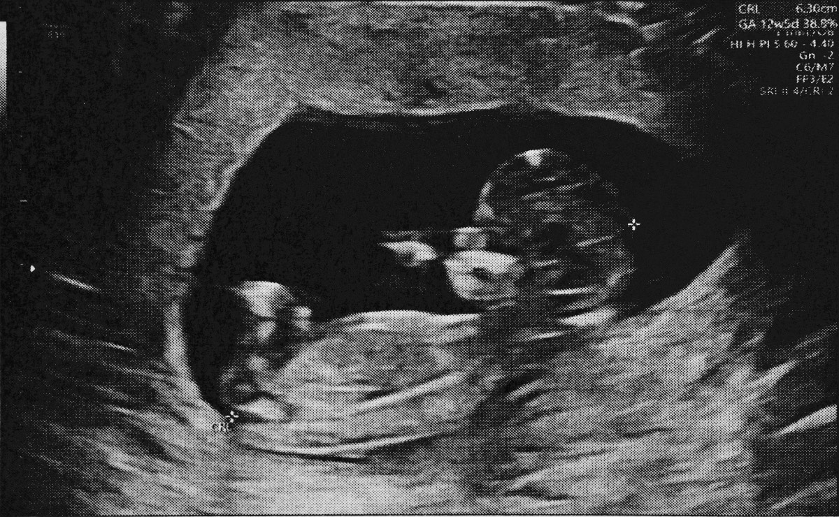 Foetus